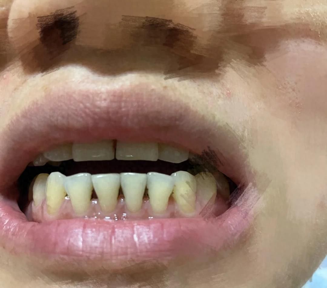 牙龈萎缩 牙根敏感 乐口优凝胶_隐形义齿 牙龈萎缩