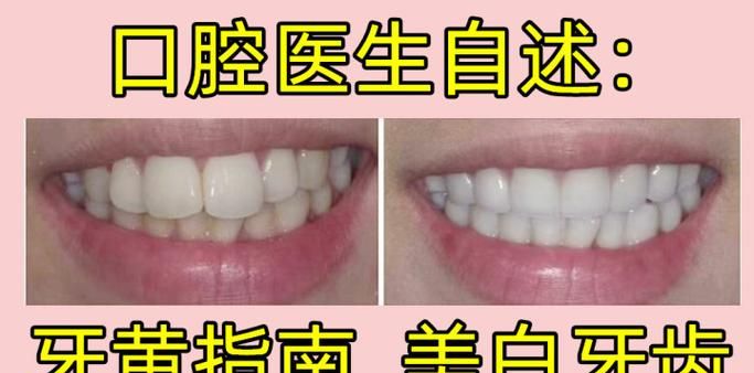 四环素牙冷光美白_四环素牙分层诊疗_四环素牙瓷贴面修复